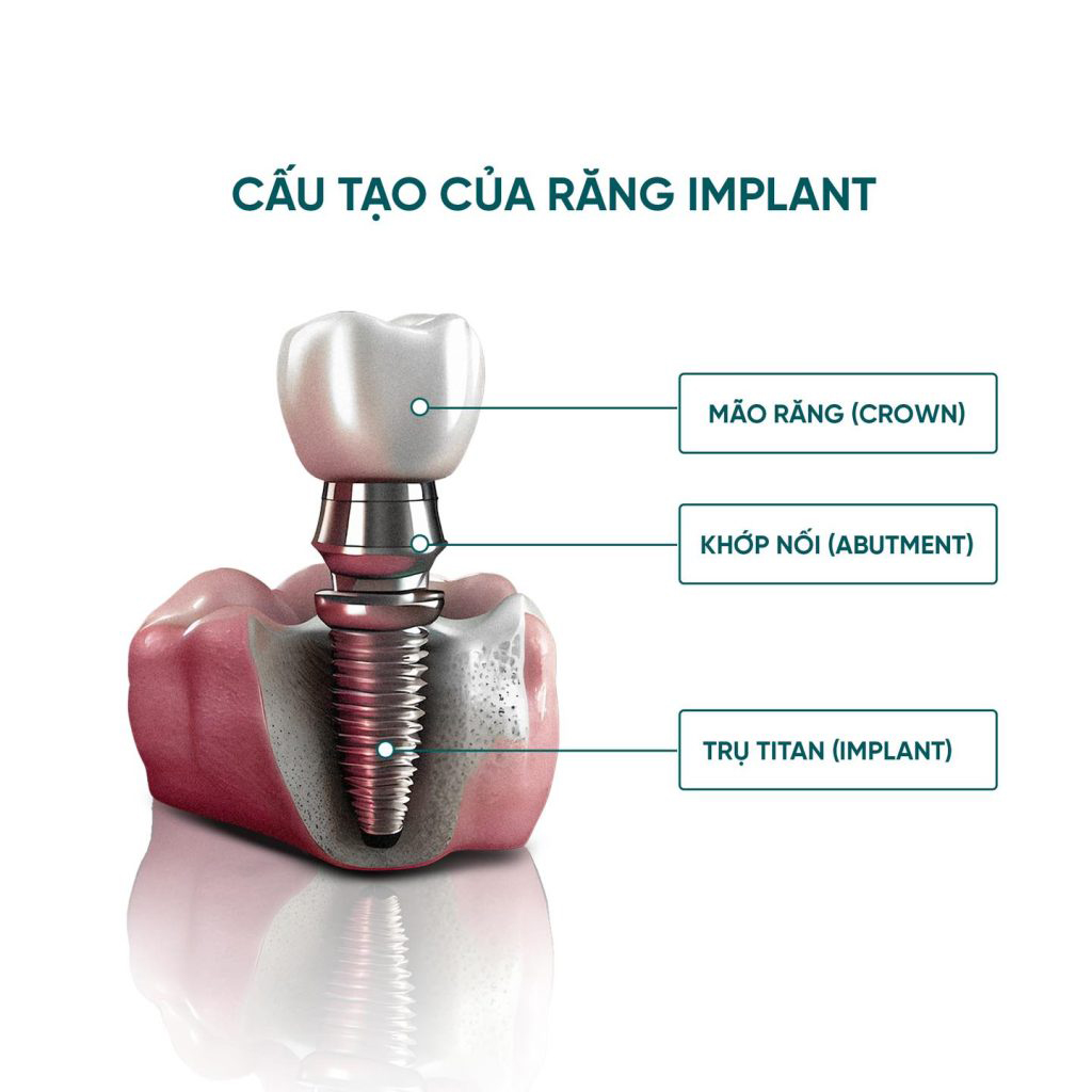 Sơ đồ cấu tạo trụ Implant