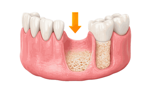 Minh hoạ mất răng lâu năm gây tiêu xương