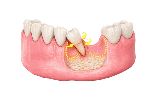 Minh hoạ răng lung lay sắp mất
