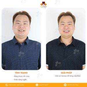 dán sứ Veneer