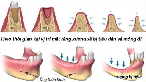 Mất răng là nguyên nhân chủ yếu gây Tiếu Xương Hàm