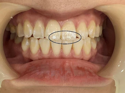 Đốm trắng trên răng trẻ em