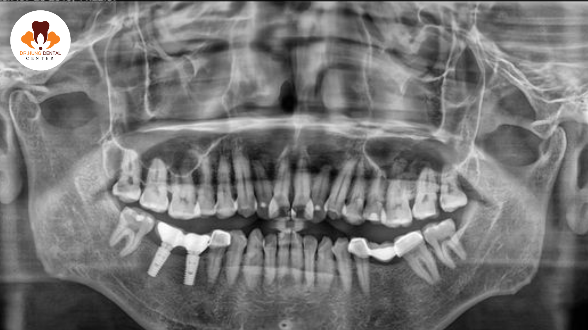 Trồng răng Implant không đau