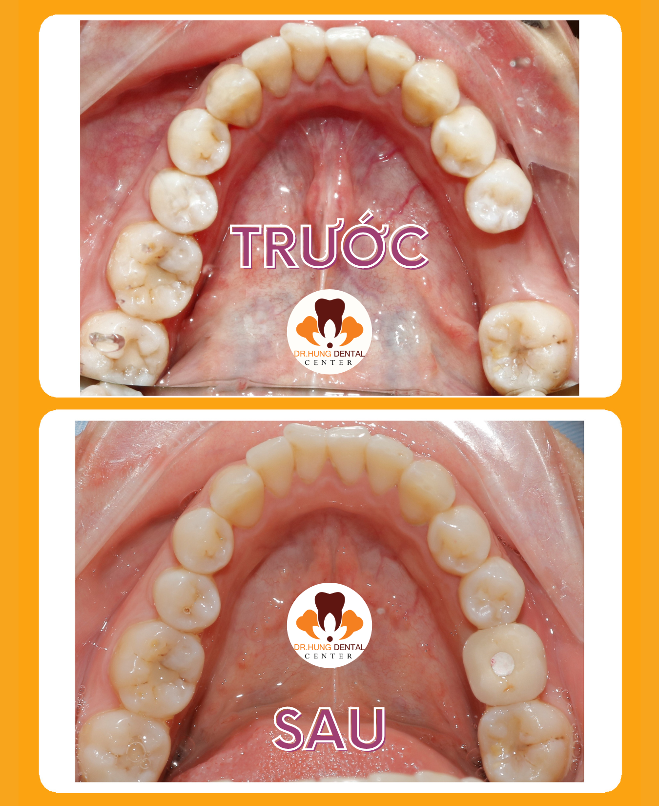 Trồng răng Implant giá rẻ