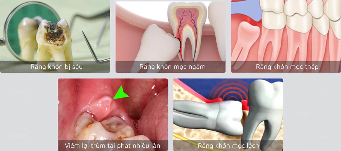 4. Khi Nào Cần Phải Nhổ Răng Khôn?