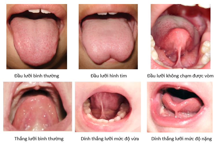 Cắt thắng lưỡi có đau không