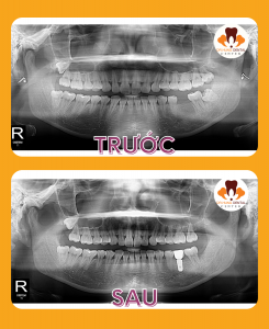 trồng răng implant