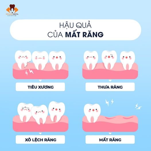 Mất răng số 6 và số 7