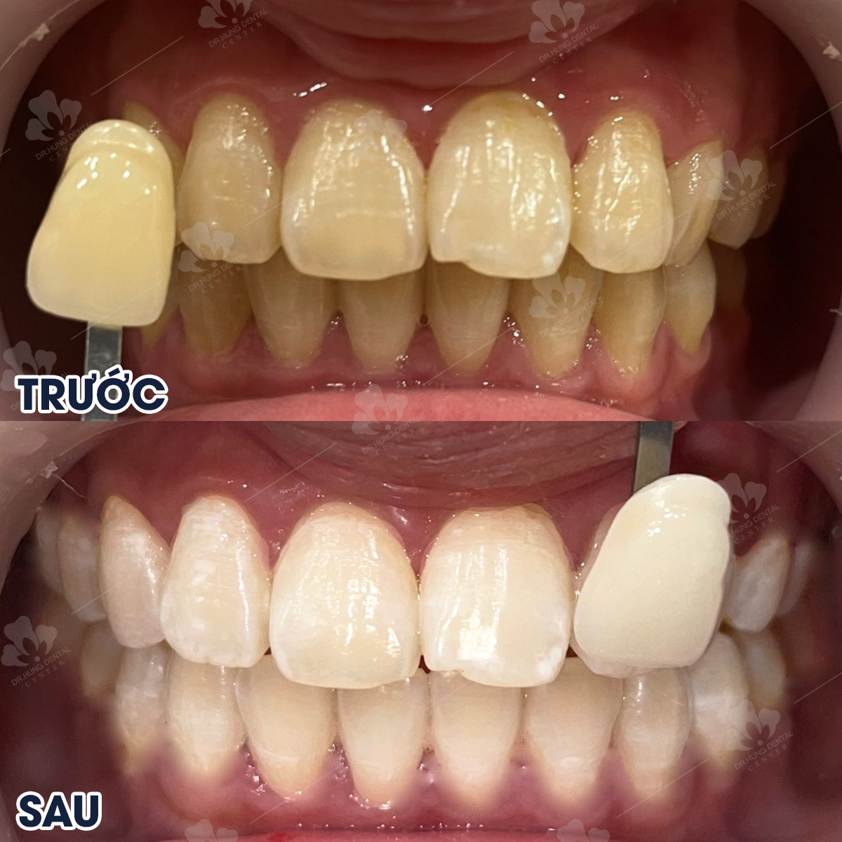 Tẩy trắng răng tại gia lâm