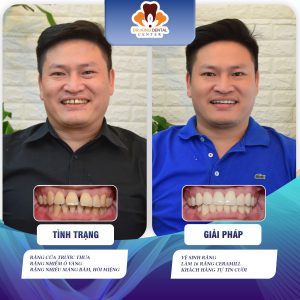 16 răng sứ Ceramill công nghệ Đức