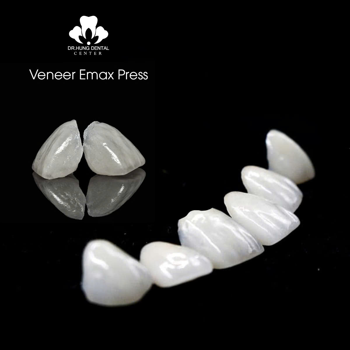 Dán sứ veneer Emax Press