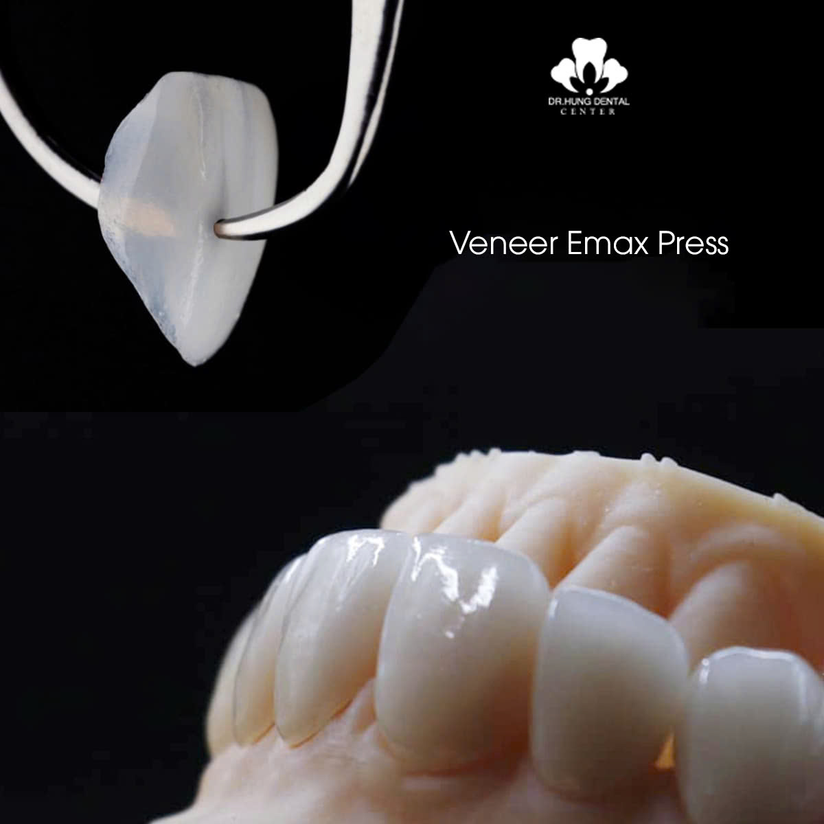 Dán sứ veneer Emax Press