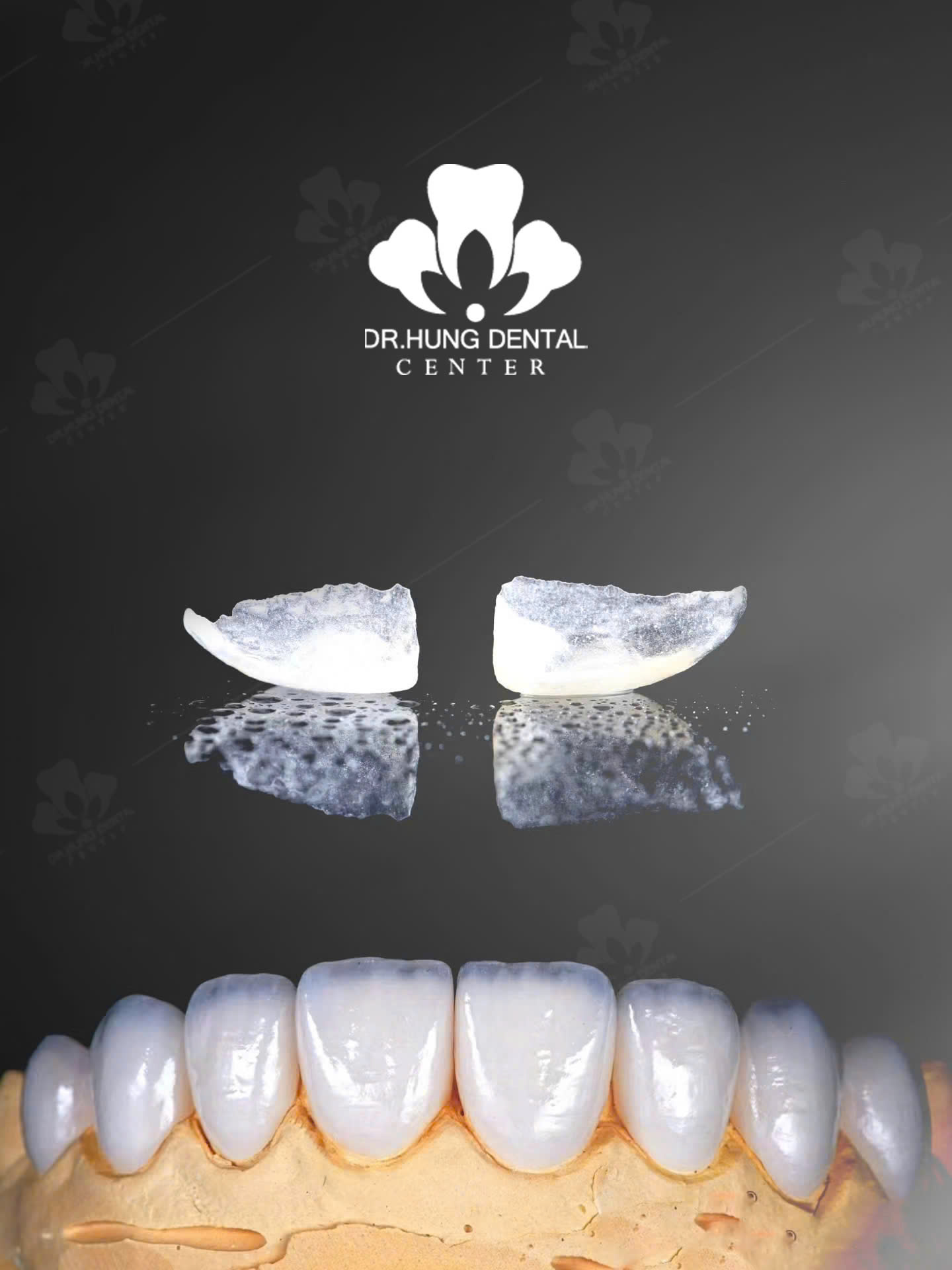 Dán sứ veneer Emax Press