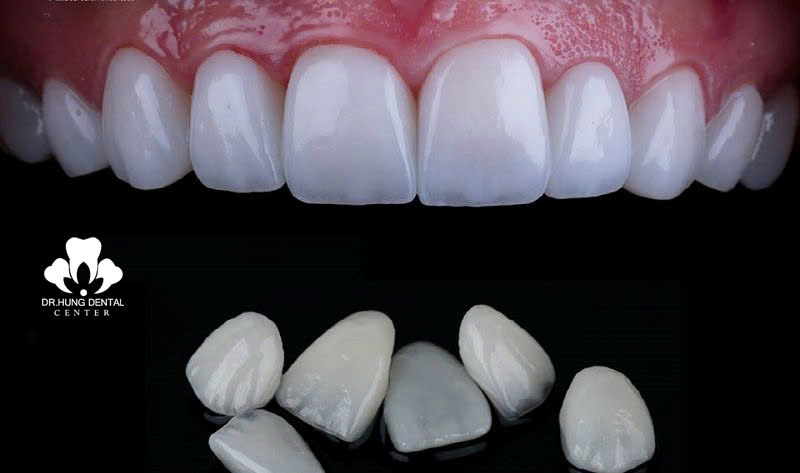 Dán sứ veneer Lisi Press