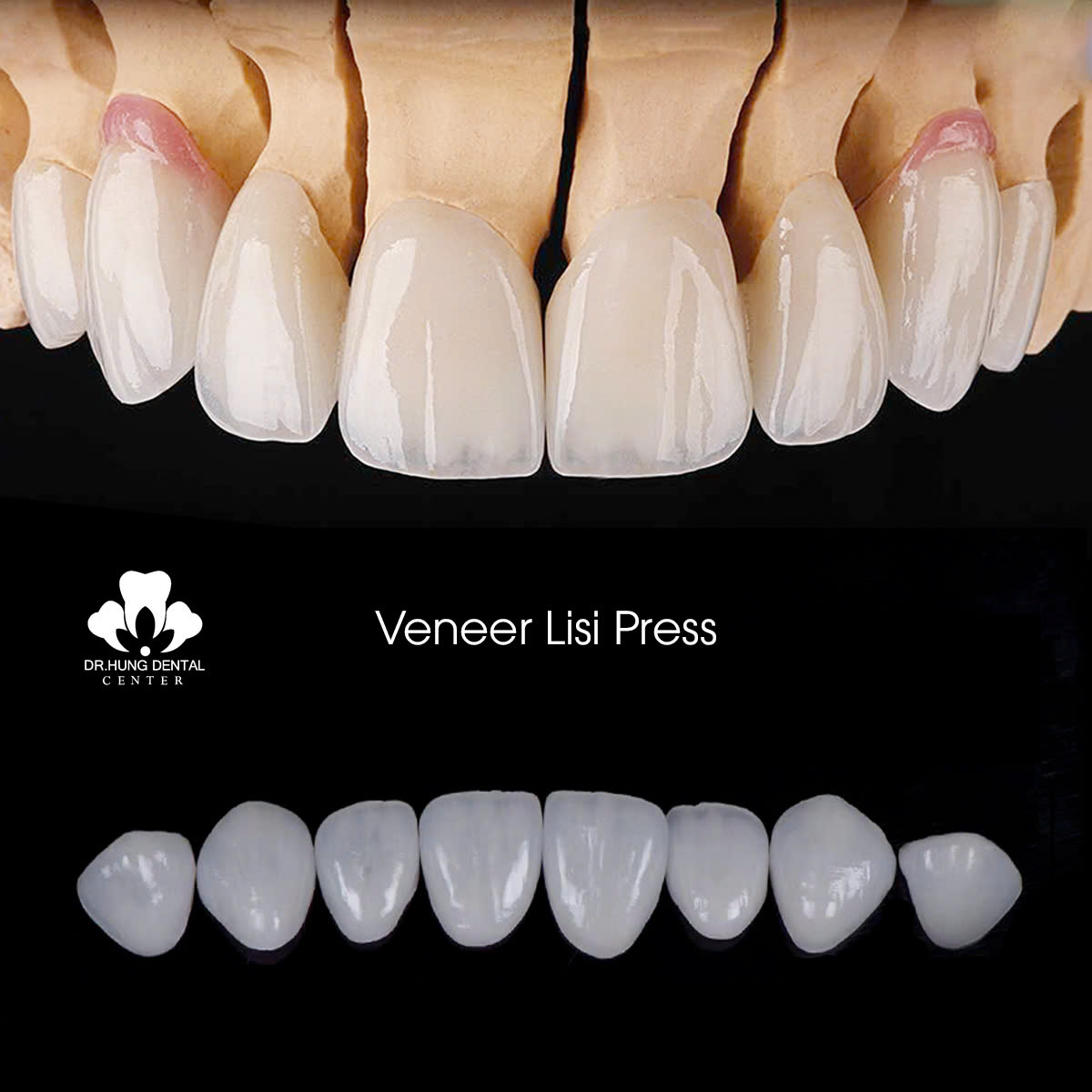 Dán sứ veneer Lisi Press