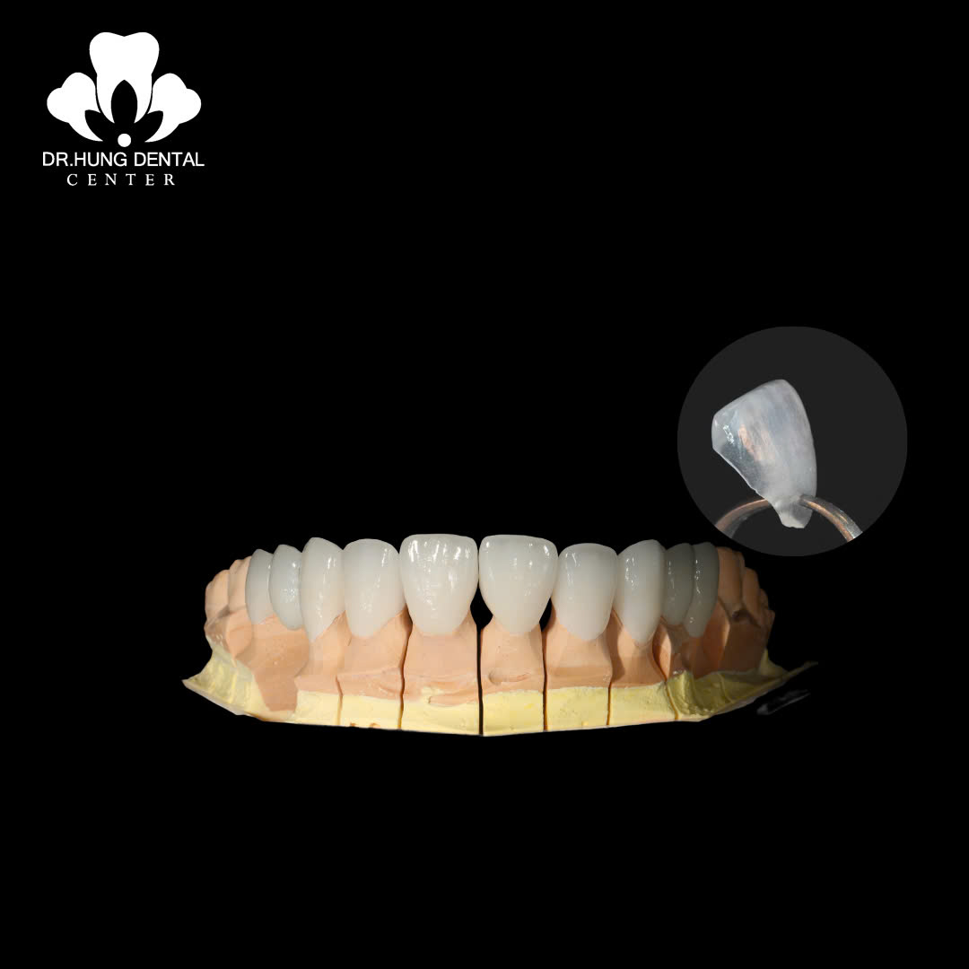 Dán sứ veneer Lisi Press
