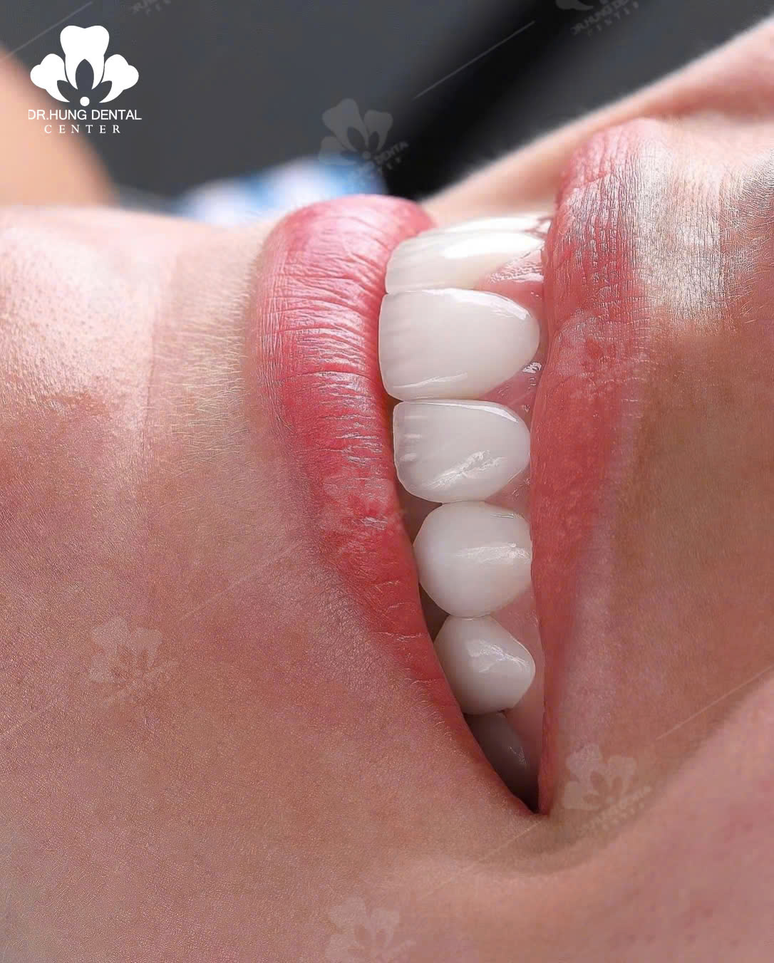Răng sứ Ceramil