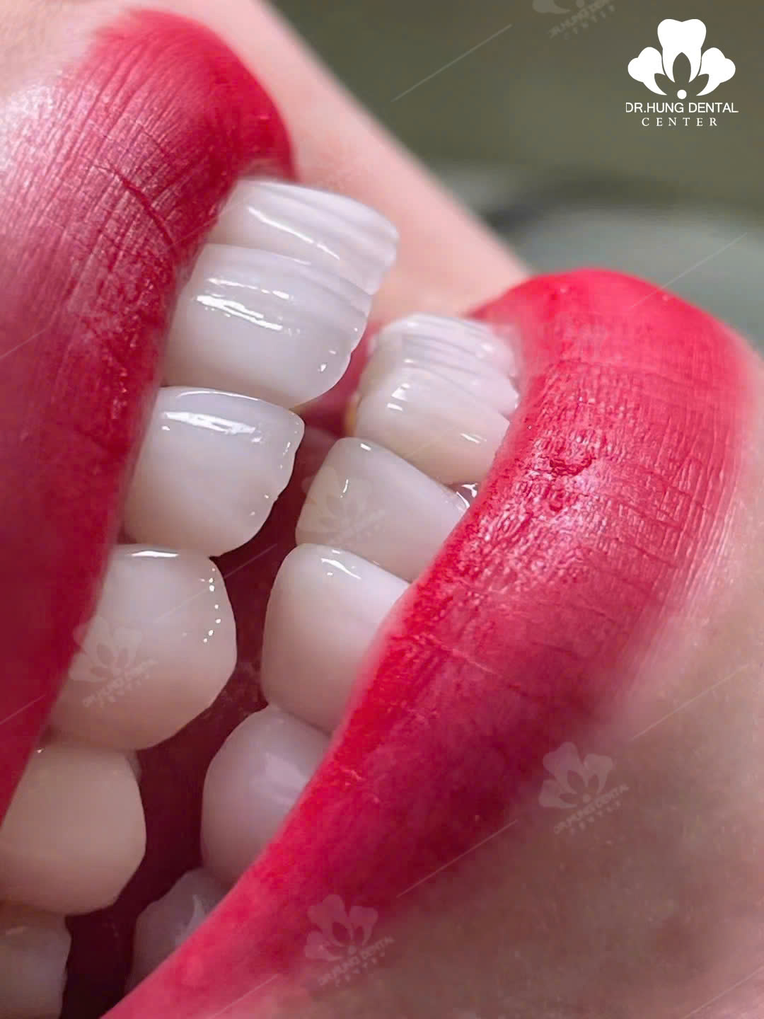 Răng sứ HT Smile