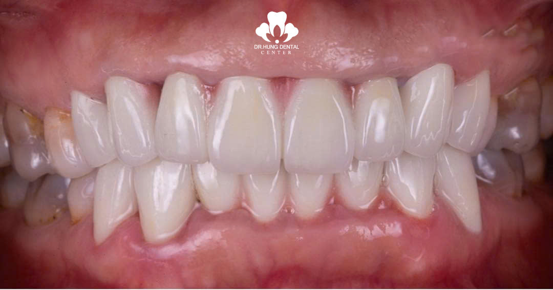 Răng sứ kim loại Titan