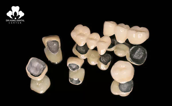 Răng sứ kim loại Titan