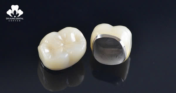 Răng sứ kim loại Titan