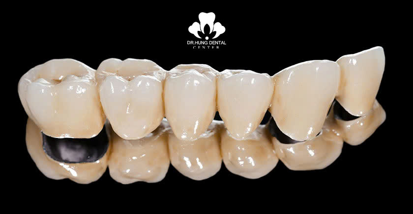 Răng sứ kim loại Titan