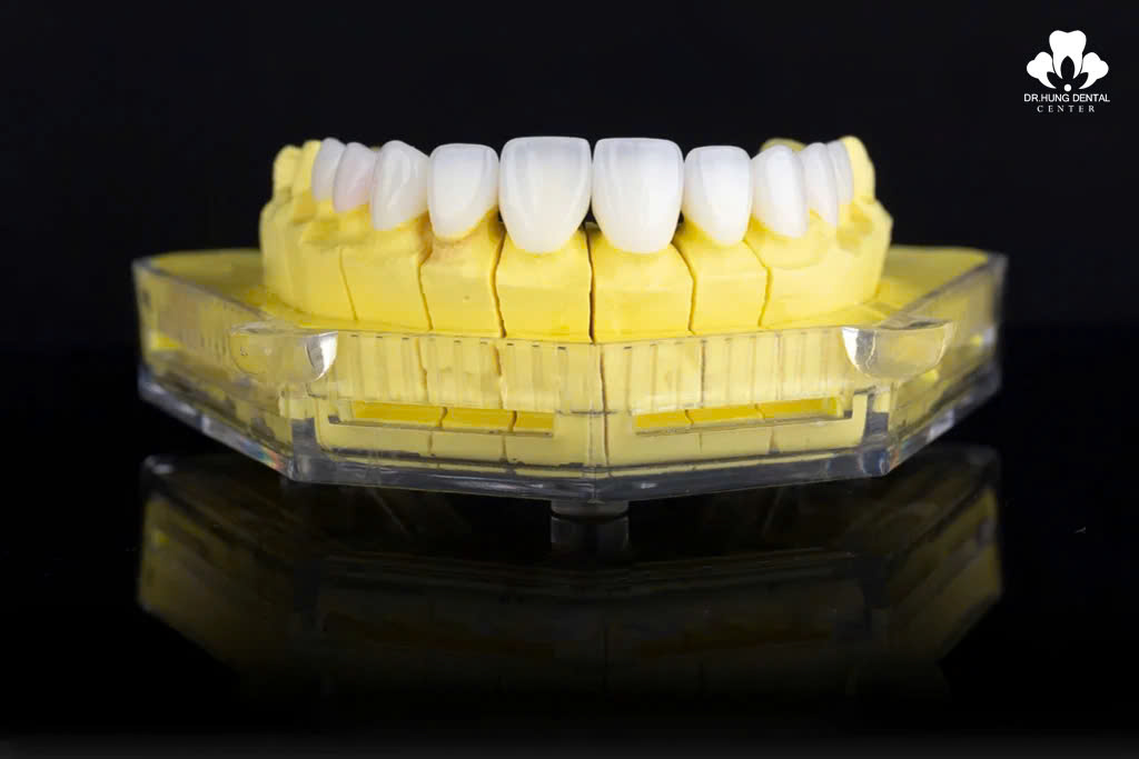 răng sứ Orodent Gold