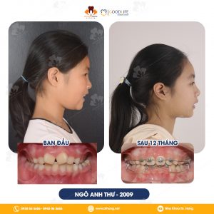 Niềng Răng Sớm Cho Trẻ Em