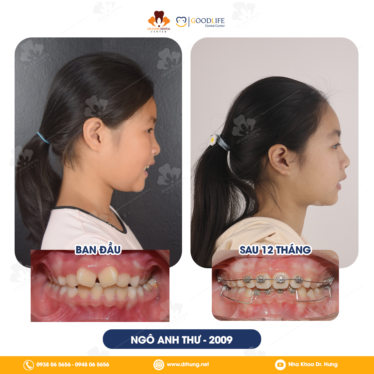 Niềng Răng Sớm Cho Trẻ Em