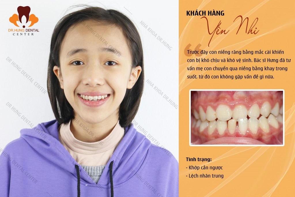 Niềng Răng Trẻ Em Bằng Invisalign