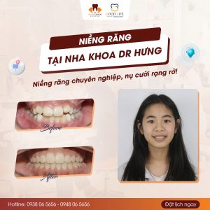 Niềng răng trẻ em không đau