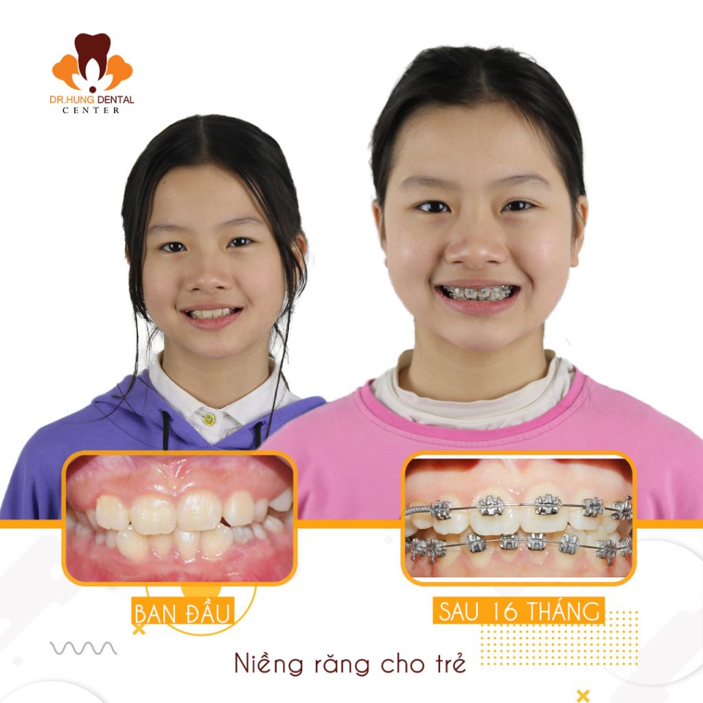 Niềng răng trẻ em không đau