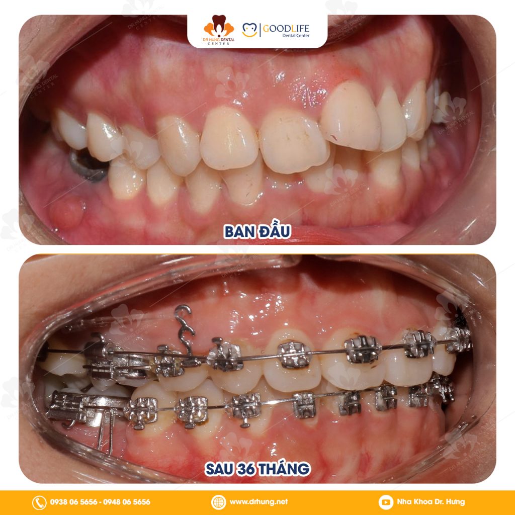 Niềng Răng Trẻ Em Bao Lâu