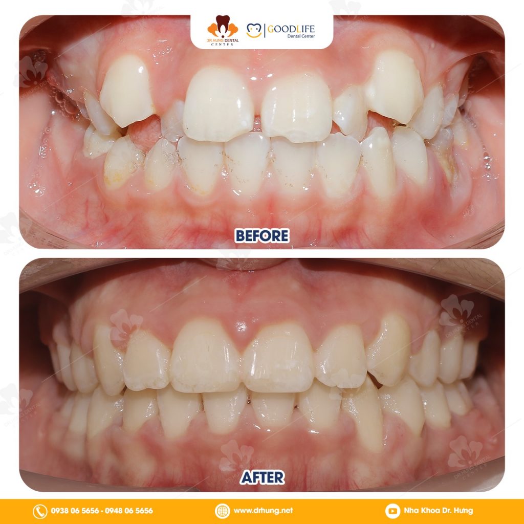 Niềng Răng Trẻ Em Bao Lâu