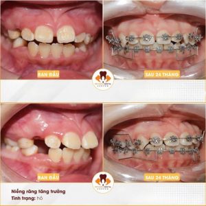 Niềng Răng Trẻ Em Bao Lâu