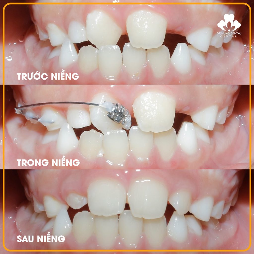 Niềng Răng Trẻ Em Giá Rẻ