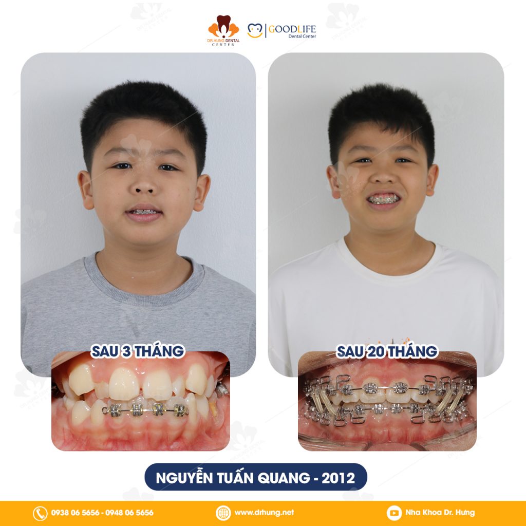 Niềng Răng Trẻ Em Giá Rẻ