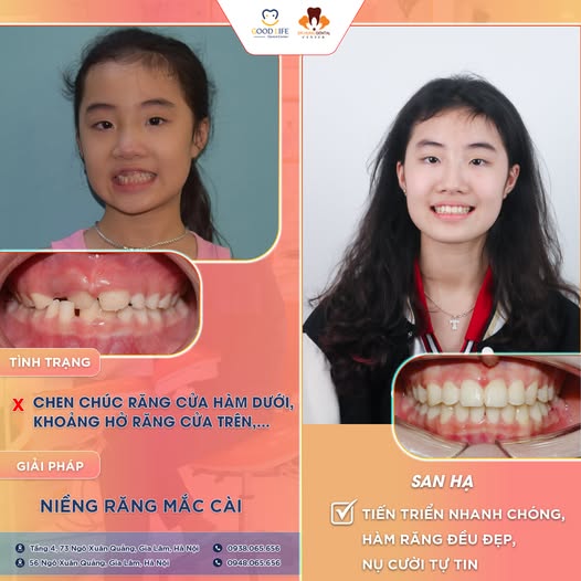 Niềng Răng Trẻ Em Giá Rẻ