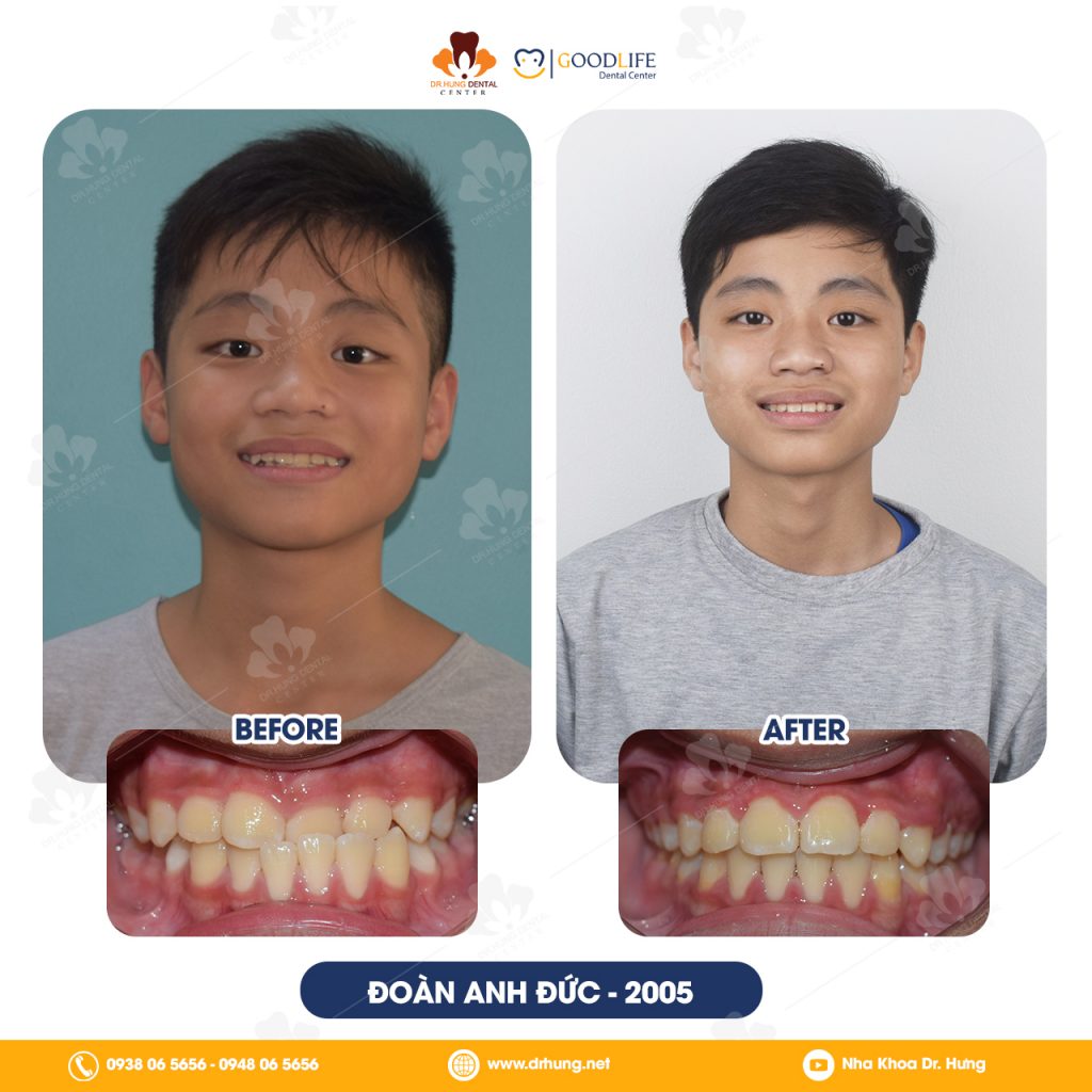 Niềng Răng Trẻ Em 7-10 Tuổi