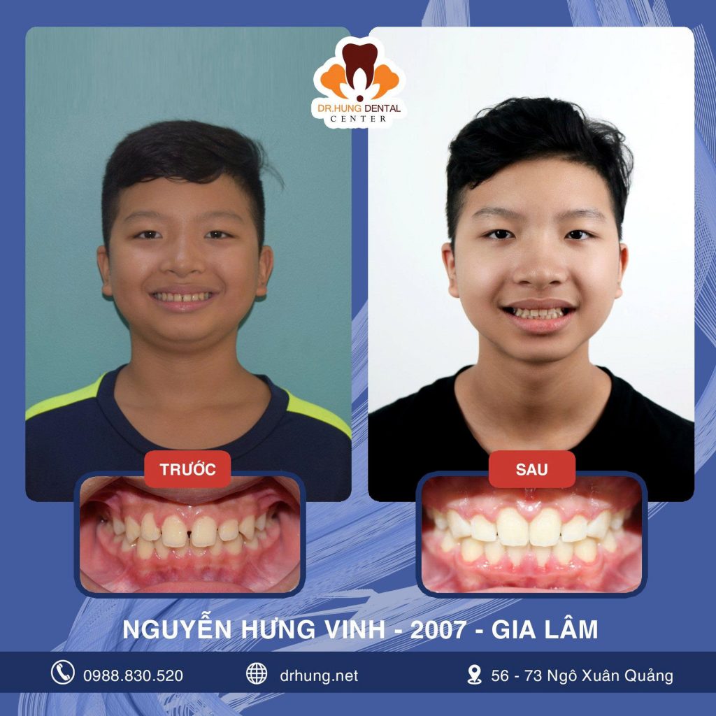 Niềng Răng Trẻ Em Ở Đâu Tốt