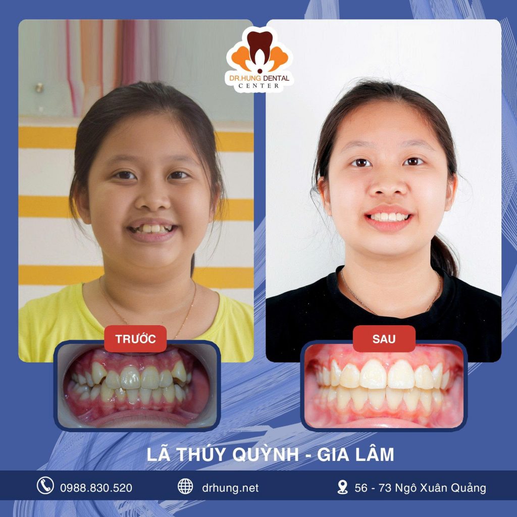 Niềng Răng Trẻ Em Ở Đâu Tốt