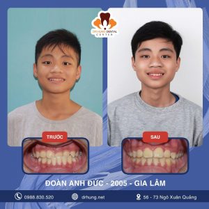 Niềng Răng Trẻ Em Ở Đâu Tốt