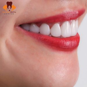 làm răng sứ Gia Lâm