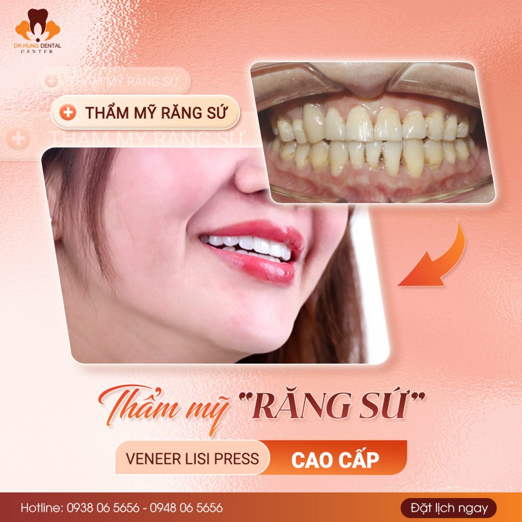 làm răng sứ Gia Lâm