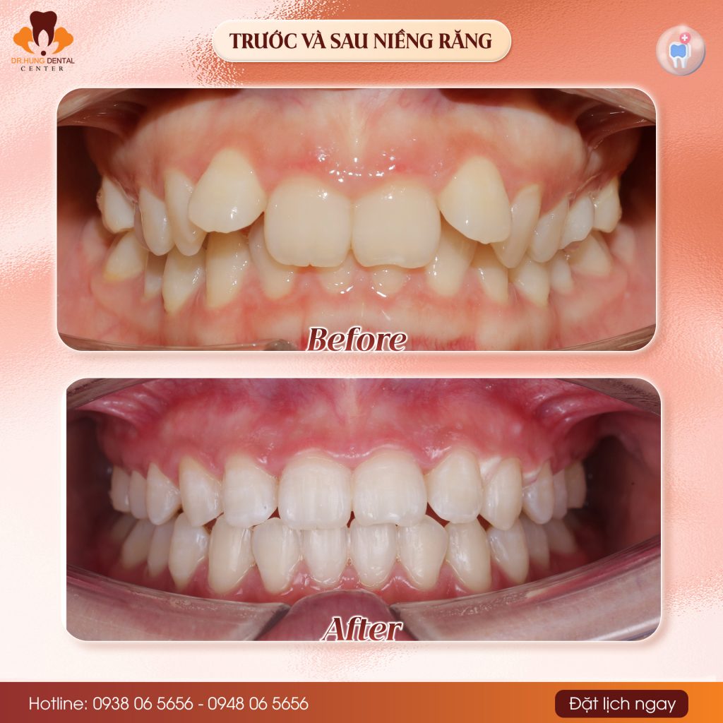 Niềng răng tại Gia Lâm