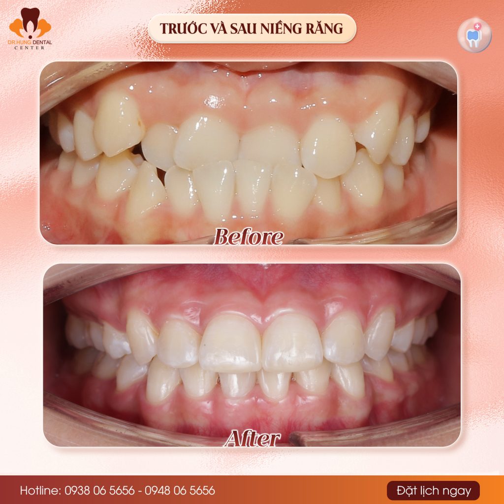 Niềng răng tại Gia Lâm