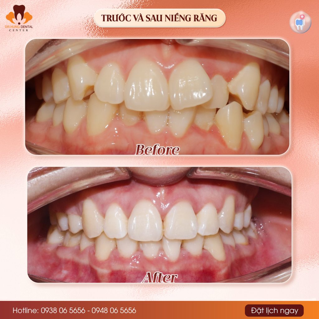 Niềng răng tại Gia Lâm