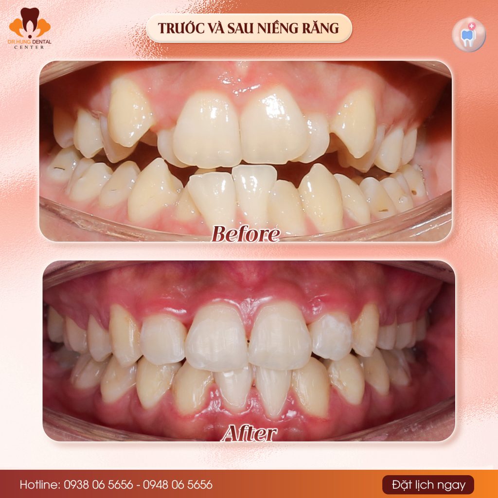 Niềng răng tại Gia Lâm