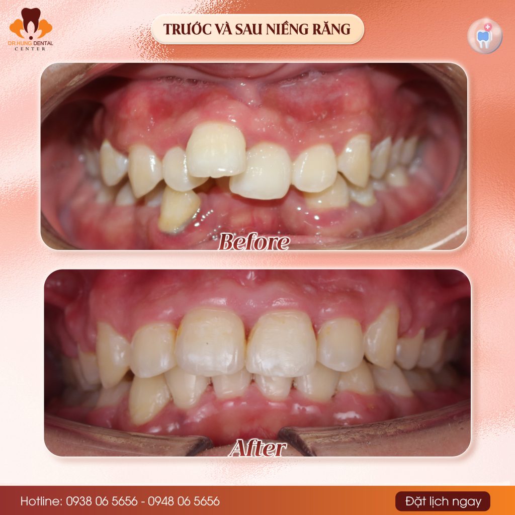 Niềng răng tại Gia Lâm