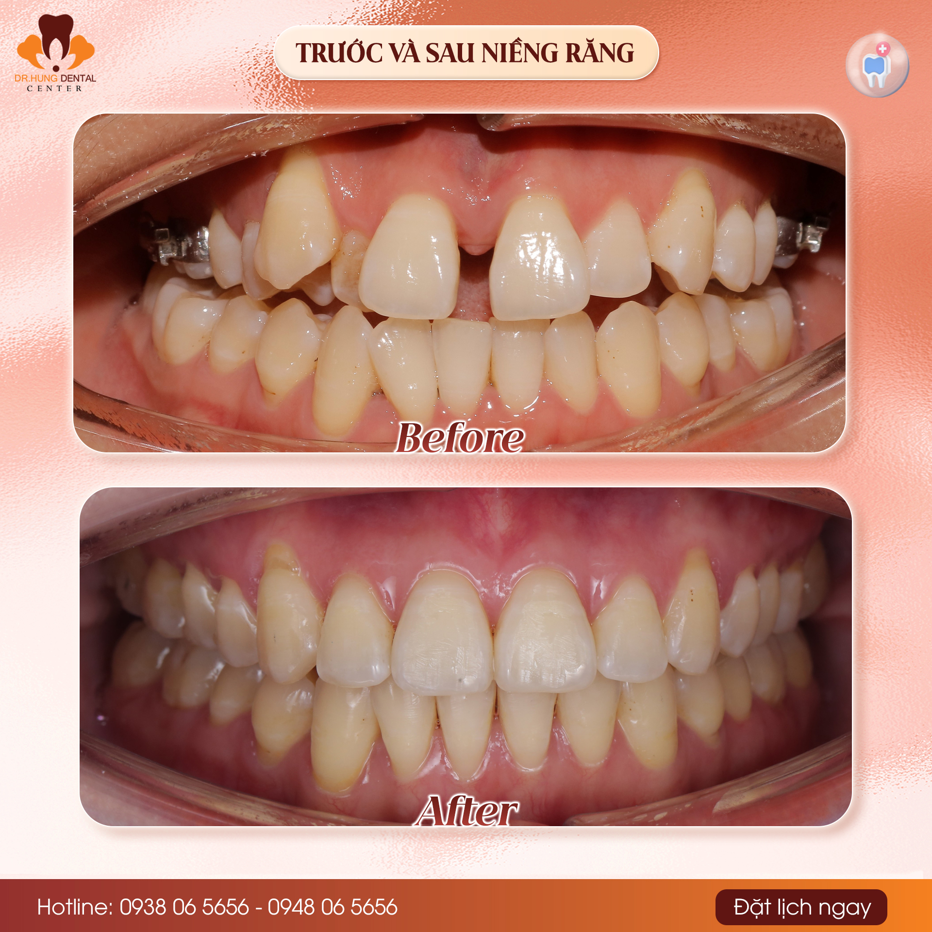 Niềng răng tại Gia Lâm